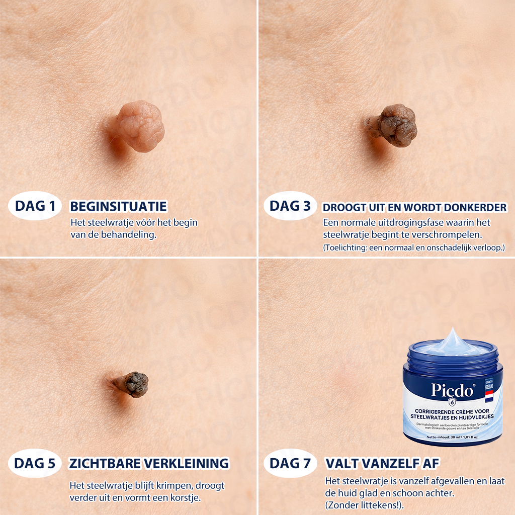 🎁 𝐏𝐢𝐜𝐝𝐨® 𝟕-𝐃𝐚𝐠𝐞𝐧 𝐇𝐮𝐢𝐝𝐥𝐢𝐩𝐣𝐞𝐬- & 𝐕𝐥𝐞𝐤𝐤𝐞𝐧𝐯𝐞𝐫𝐰𝐢𝐣𝐝𝐞𝐫𝐢𝐧𝐠𝐬𝐜𝐫è𝐦𝐞 (Pijnloze Formule – Zonder Littekens)☀️